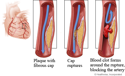 Graphic showing arterial disease