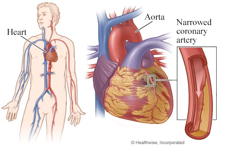 Diagram of coronary bypass