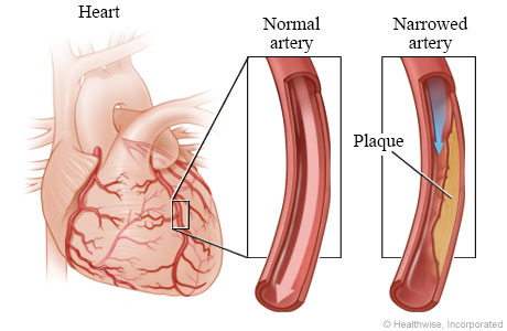 Graphic showing the heart and narrowed arteries